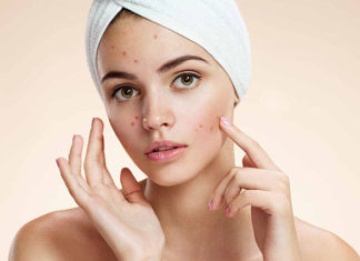 Jak walczyć z trądzikiem? Jak walczyć z trądzikiem